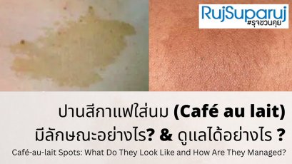 ปานสีน้ำตาล มีลักษณะอย่างไร & ดูแลได้อย่างไร?