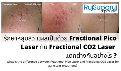 เจาะลึกความแตกต่าง: Fractional CO2 vs Fractional Picosecond Laser ในการรักษาหลุมสิว