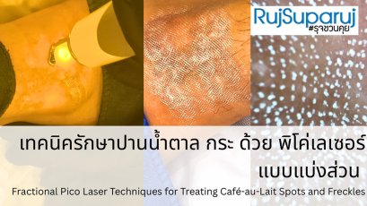 เทคนิครักษาปานน้ำตาล กระ ด้วย พิโค่เลเซอร์แบบแบ่งส่วน Fractional Pico Laser Techniques for Treating Café-au-Lait Spots and Freckles