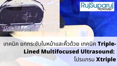 เทคนิคการยกกระชับใบหน้าและคิ้วด้วย Triple-Lined Multifocused Ultrasound: โปรแกรม X-Triple
