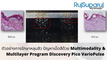 ตัวอย่างการรักษาหลุมสิว ปัญหาเม็ดสีด้วย Multimodality & Multilayer Program Discovery Pico VarioPulse
