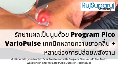 รักษาแผลเป็นนูนด้วย Program Pico VarioPulse เทคนิคหลายความยาวคลื่น + หลายช่วงการปล่อยพลังงาน