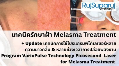 Update เทคนิคดูแลปัญหาฝ้า Melasma Treatment Update