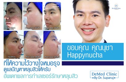 ขอบคุณ คุณนุชา #happynucha ที่ให้ความไว้วางใจหมอรุจ ดูแลปัญหาหลุมสิวให้ครับ / อัพเดทผลการทำเลเซอร์รักษาหลุมสิว /