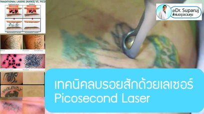 เทคนิคลบรอยสักด้วยเลเซอร์ Picosecond Laser
