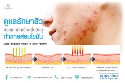 ดูแลรักษาสิวด้วยเทคนิคเข็มคลื่นวิทยุทำลายต่อมไขมัน Micro Insulated Needle RF Acne Resolve