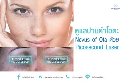 ดูแลปานดำโอตะ Nevus of Ota ด้วย Picosecond Laser