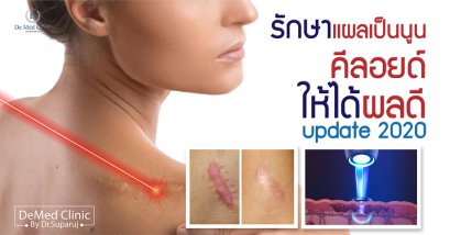 รักษาแผลเป็นนูน คีลอยด์ ให้ได้ผลดี update 2020 