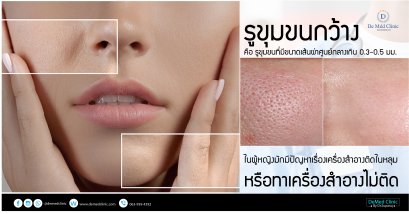  รูขุมขนกว้าง คือรูขุมขนที่มีขนาดเส้นผ่าศูนย์กลางเกิน 0.3-0.5 มม.  ในผู้หญิงมักมีปัญหาเรื่องเครื่องสำอางติดในหลุมหรือทาเครื่องสำอางไม่ติด