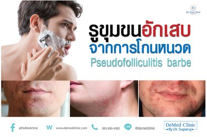 รูขุมขนอักเสบจากการโกนหนวด Pseudofolliculitis barbe