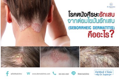 โรคหนังศีรษะอักเสบจากต่อมไขมันอักเสบ (SEBORRHEIC DERMATITIS) คืออะไร?