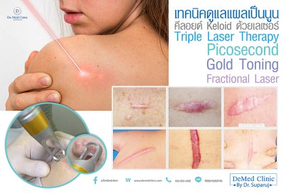เทคนิคดูแลแผลเป็นนูน คีลอยด์ Keloid ด้วยเลเซอร์ Triple Laser Therapy: Picosecond + Gold Toning + Fractional Laser  