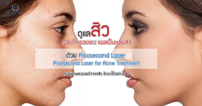 ดูแล สิว รอยดำ รอยแดง แผลเป็นหลุมสิว ด้วย Picosecond Laser  Picosecond Laser for Acne Treatment 