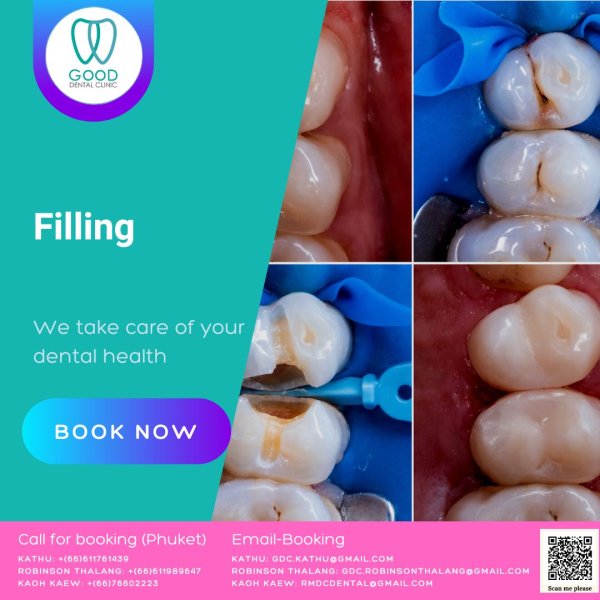 Dental Fillings gooddentalclinic