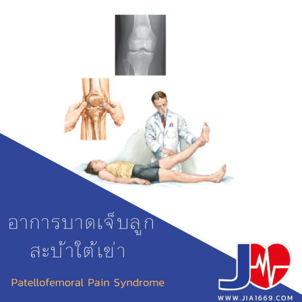 Patellofemoral Pain Syndrome jia1669