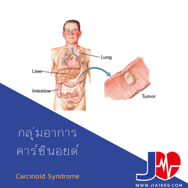 Carcinoid Syndrome jia1669