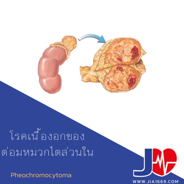 รวมกัน 103+ ภาพ ต่อ ม หมวก ไต ส่วน นอก คมชัด