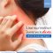 โปรแกรมรักษาโรคผิวหนังเรื้อรัง (Chronic Dermatology)