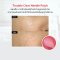 Curesys Trouble Clear Acne Patch เคียวร์ซิส ทรับเบิ้ล เคลียร์ แอคเน่ แพทช์ แผ่นแปะสิวหัวเข็ม ละลายหัวสิวเร่งด่วน (ทำลายแบคทีเรีย,  ลดอาการผิวอักเสบ, สิวยุบ)