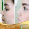 Rhinoplasty ผ่าตัดเสริมจมูก