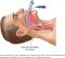 Laryngeal Mask Airway (LMA)  หรือหน้ากากครอบกล่องเสียง