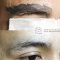 LASER TATTOO REMOVAL 