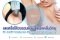 ลดเหงื่อใต้วงแขนด้วยเทคนิคคลื่นวิทยุ RF: InfiniRF Intradermal Microneedle Radiofrequency
