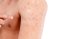 โปรแกรมเลเซอร์รักษา ขนคุด Keratosis Pilaris (KP) Treatment Program by De Med Clinic  ผิวเรียบเนียนสวย ลดผิวขรุขระคล้ายหนังไก่ ลดอาการคันรอยดำ