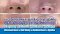 แนะนำเทคนิคดูแลแผลเป็นจากการผ่าตัด: ดูแลแผลเป็นนูนจากการผ่าตัดปีกจมูก Alarplasty ด้วยเทคนิค MultiLaser Therapy: Picosecond Laser + Gold Toning + Fractional Laser + Injection