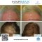 HairMax LaserBand 41 – ComfortFlex แบบที่ผมคาดผม ***พิเศษเฉพาะที่ DeMed Clinic เท่านั้น*** / ิแถมพิเศษโปรแกรม Triple H Treatment ดูแลผมร่วงผมบาง1 ครั้ง