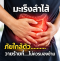 COLON CANCER