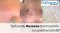 โรคโรซาเชีย Rosacea มีอาการอย่างไร และดูแลรักษาอย่างไร?