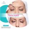 แก้ปัญหาหนังตาตก ตาสองชั้นหลบในโดยไม่ต้องผ่าตัดด้วย “Plasma eyelift” Plasma eyelift: Non surgical double eyes lit (blepharoplasty)