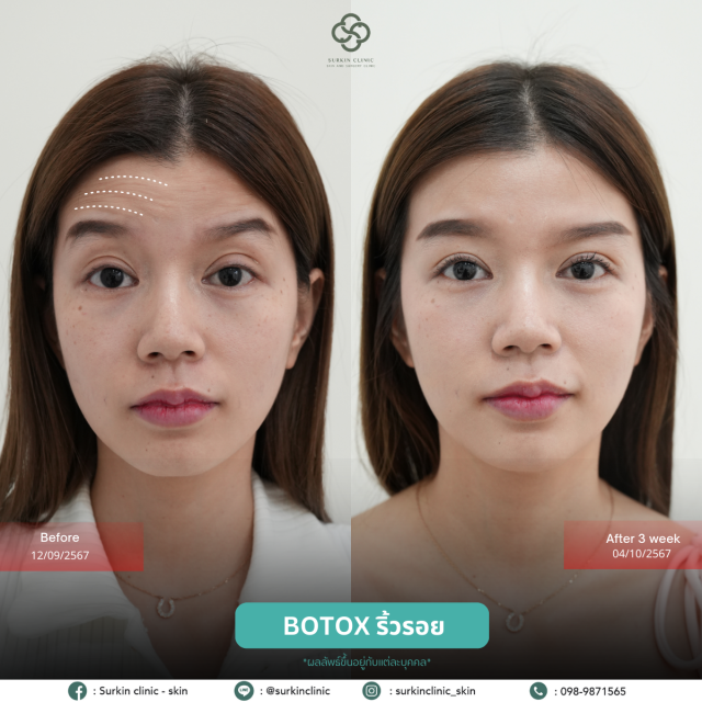 Botox 1 - surkinclinic.com