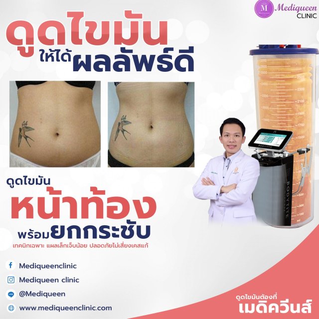 Lipo Promo 1